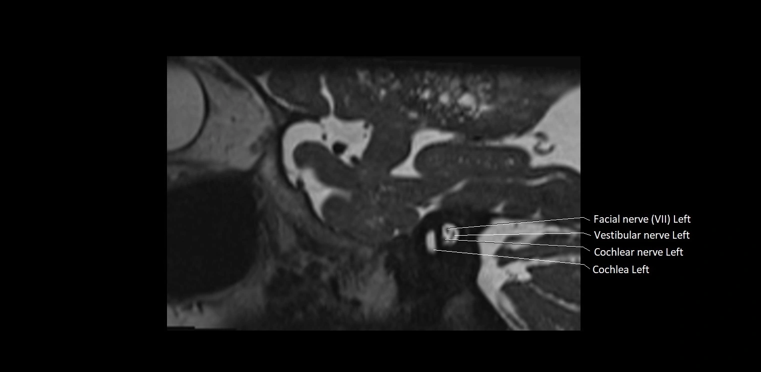 Cranial nerve sagittal anatomy MRI 3T image 10.webp